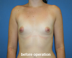 plastic-surgery-breast-augmentation